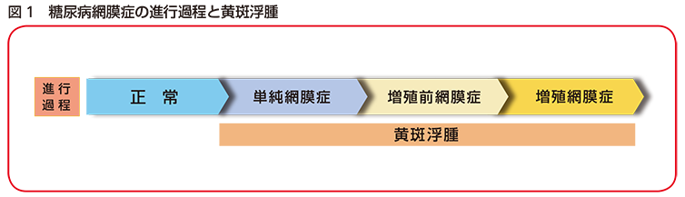 糖尿病黄斑浮腫