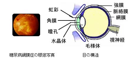 糖尿病網膜症の眼底写真　目の構造：虹彩、角膜、瞳孔、水晶体、強膜、脈絡膜、網膜、視神経、毛様体
