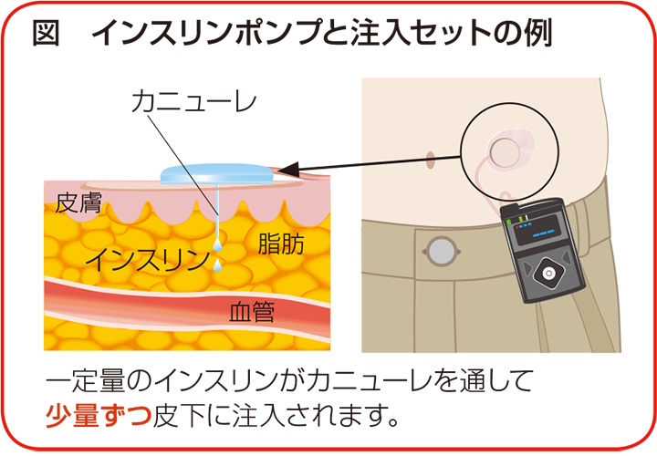 持続皮下インスリン注入療法
